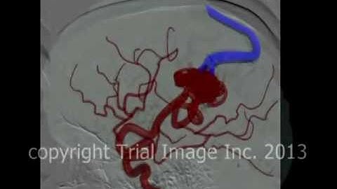 AVM - arteriovenous malformations in the brain & cerebral hemorrhage- animation by Cal Shipley, M.D.