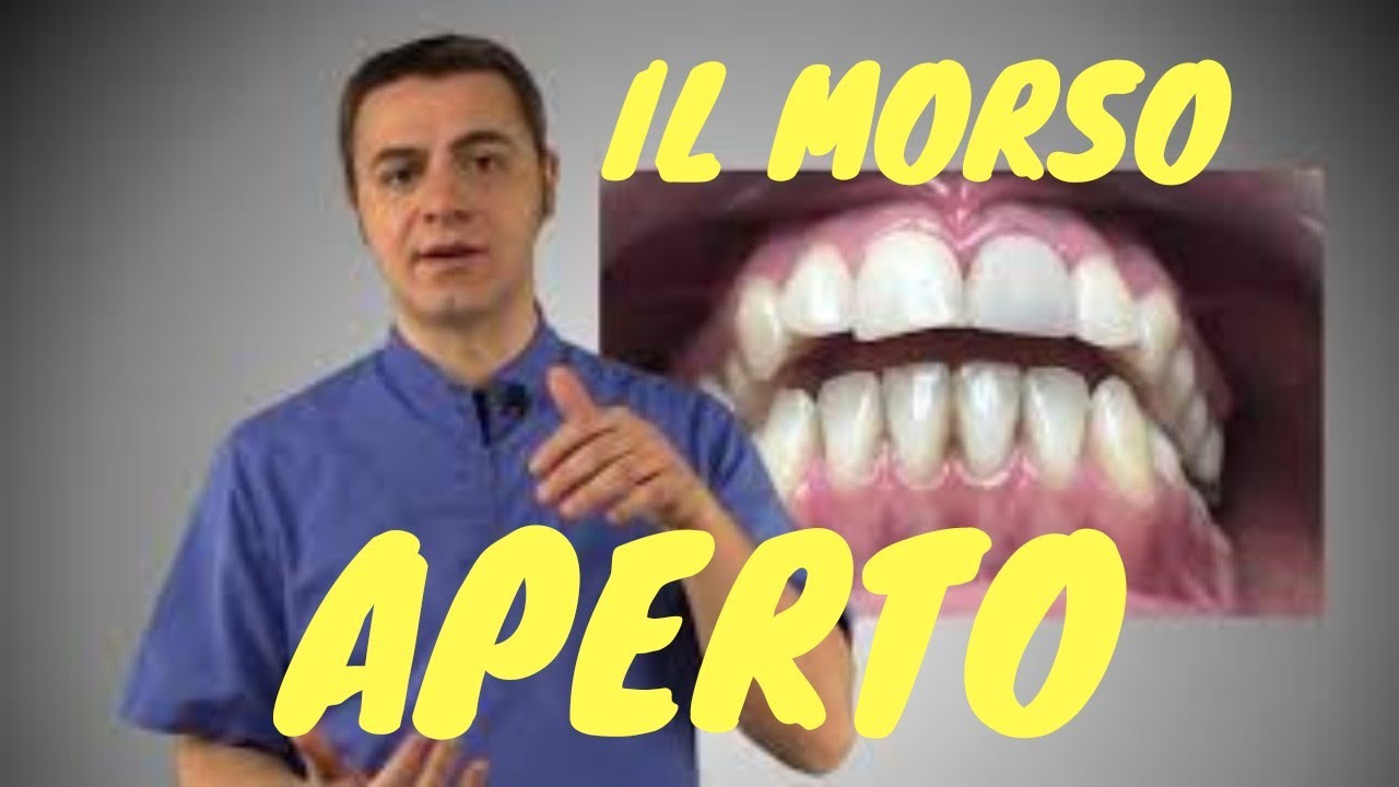 Il Morso Aperto