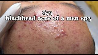 |675| Blackhead acne of a men ep3