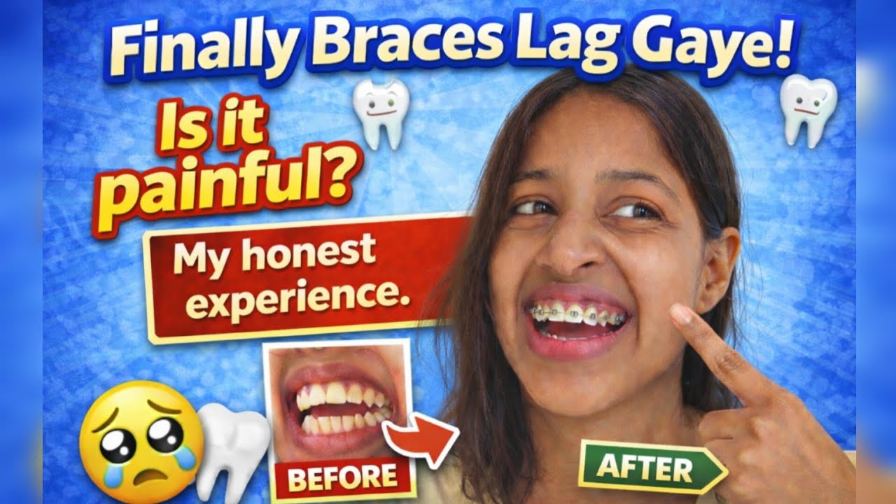Finally Braces Lag Gaye! 🦷😬 | My Honest Experience | Pain Kitna Hota Hai? | Braces Journey Part 2