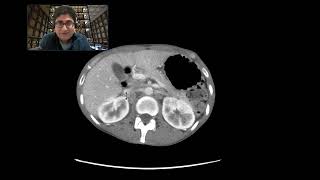 Metastatic gastric cancer