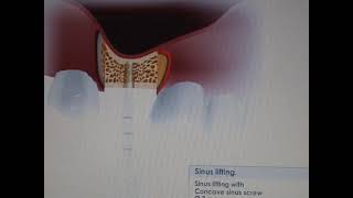 Sinus lift video :using MISImplants Bone compression kit