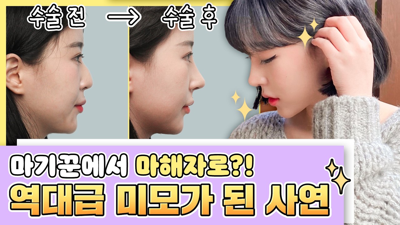 코성형 전후 역대급 차이 체감 짤 mp4. (리얼모델 전후)