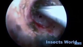 Ultimate Insects inside the human body Best compilation 2015