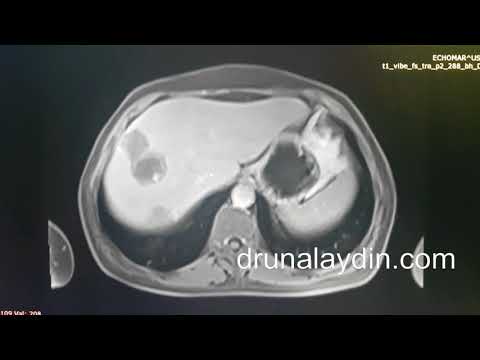 Evre 4 Kalın Bağırsak Kanseri Karaciğer Metastazı Ameliyatı
