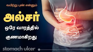 Stomach Ulcers : Don’t Ignore the WARNING Signs | 24 Tamil Health