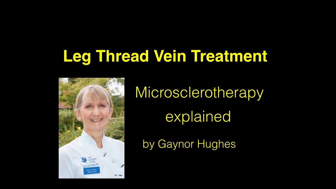 Microsclerotherapy Microsclerotherapy For Leg Spider Veins - YouTube