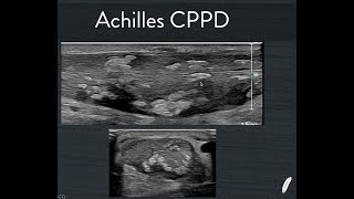 Achilles Cppd