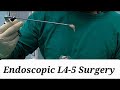 Endoscopic L4-5 Slip Disc Surgery ( Disc prolapse/herniation/ Lumbar disc PIVD operation).
