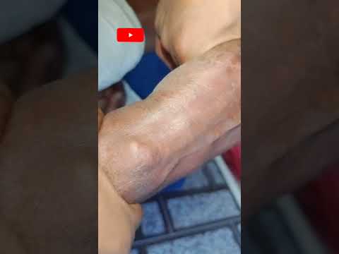 Cannulation video part 367  shorts  viral