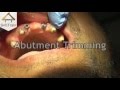 Abutment Trimming (Hindi) (हिन्दी)