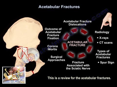 Video: Vad är en acetabulär fraktur?