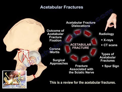 Video: Wat is een acetabulumfractuur?