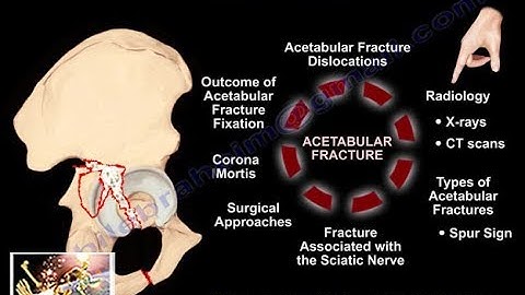 A Review Of Acetabular Fractures - Everything You Need To Know - Dr. Nabil Ebraheim