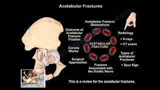 A Review Of Acetabular Fractures - Everything You Need To Know - Dr. Nabil Ebraheim