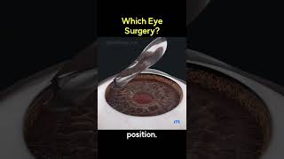 LASIK vs SMILE | 3D Animation