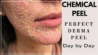 Chemical Peel Perfect Derma Peel - Day By Day Post Procedure By Sarv
