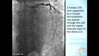 Retrograde Recanalization of Circumflex Artery CTO - Khelimskii, DA; Krestyaninov, OV