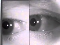 Physiologic (End-Gaze) Nystagmus