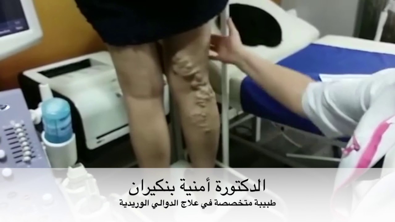 الدكتورة أمنية بنكيران : أهمية تشخيص الدوالي الوريدية عند طبيب أخصائي في الدوالي و الشرايين.