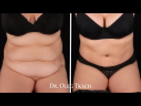 Результат пластики живота и липосакции боков | Абдоминопластика до и после | Липосакция Киев