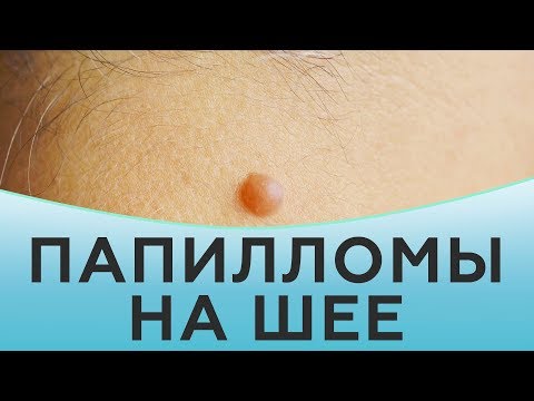 Папилломы на шее