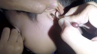 Big Black Earwax STUCK in Boy's Ear Removed by Earwax Specialist 27,768 views 3 months ago 1 minute