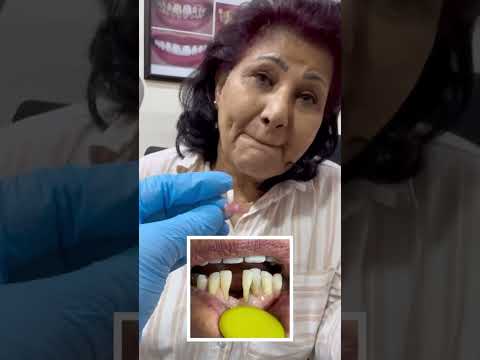 شريط الريبوند الامريكي دكتوره دينا القيسي افضل طبيب اسنان في العراق تجميل الاسنان في العراق اربيل