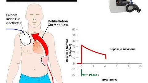 Waveform Visualization of a Biphasic Defibrillator