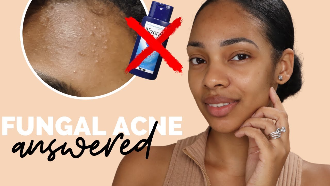 How to Treat Fungal Acne (malassezia) | FAQs