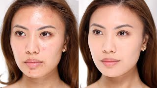 How to cover acne *NO FOUNDATION MAKEUP*