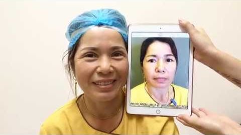 Chỉnh Đôi Mắt Sụp Mí Bằng Cắt Mí Mani Open Deep 5D Tại Dr.Hải Lê.