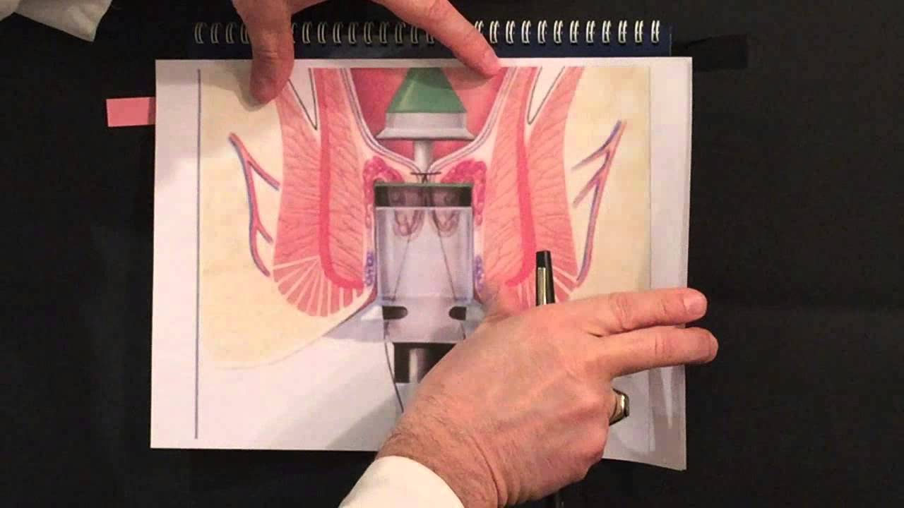 Emorroidi - Come si interviene chirurgicamente