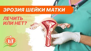 👉 Эрозия шейки матки - лечить или нет?