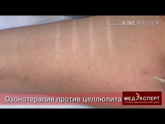 Озонотерапия против целлюлита