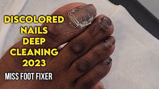 CLEANING TOENAIL 🦶🏽:  DISCOLORED TOENAILS DEEP CLEANING BY FAMOUS PODIATRIST MISS FOOT FIXER