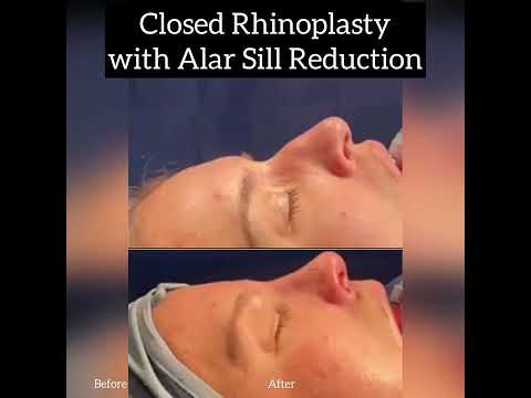 Video thumbnail: Closed Rhinoplasty with Alar Sill Reduction @AlbertPlasticSurgery