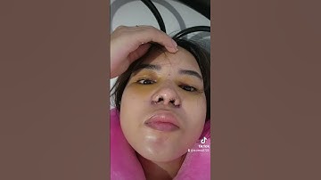 My Rhinoplasty journey🥰.