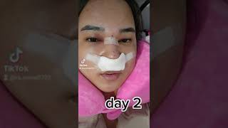 My Rhinoplasty Journey