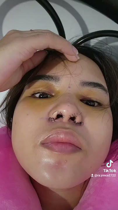 My Rhinoplasty journey🥰.