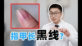 指甲长黑线，天生美甲还是癌症前兆？
