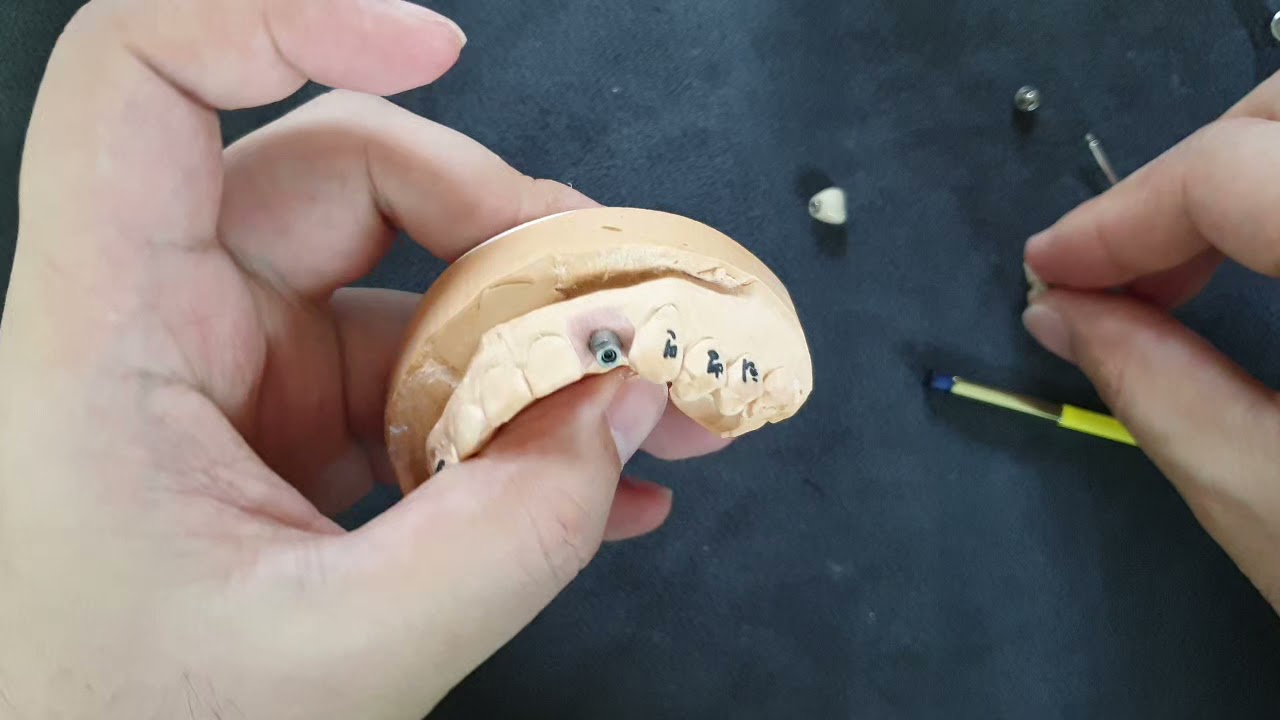 하이니스 임플란트 (Highness implant) 보철 체결 어떻게?