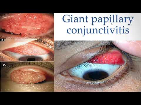 контакт линзтэй холбоотой нүдний өвчнүүд