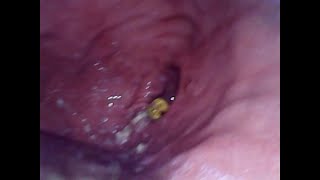 3 Gummy Bears | Stomach Sphincter View! | Endo Cam