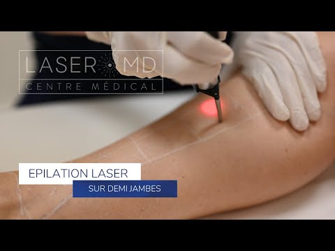 Epilation laser sur