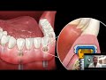 Dental Implant Overdenture | Snap-In Dentures