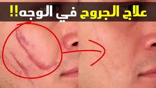 علاج علامات الجروح في الوجه!! التخلص من الحفر في الوجه!! الدكتور جمال الصقلي