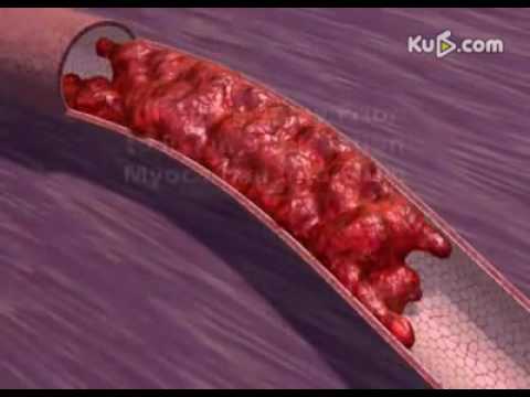 Video: Arteri Koronari Circumflex Hypoplastic Terisolasi: Penyebab Jarang Infark Miokard Haemorrhagic Dalam Atlet Muda