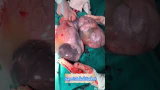 Caul birth with sac | عملية ولادة قيصرية لتوأم