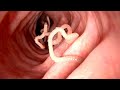 Multiple Colon worms during colonoscopy